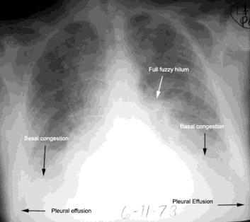 5 widoczne radiologiczne wykładniki zastoju krwi nad płucami : linie B Kerley a Poszerzenie naczyń wnękowych Płyn w jamach