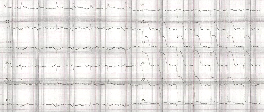 Rycina 1A. EKG przy przyjęciu opis w tekście.