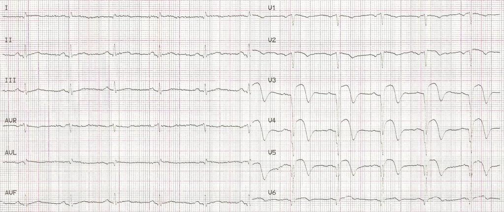 Rycina 1B. EKG przy wypisie opis w tekście.