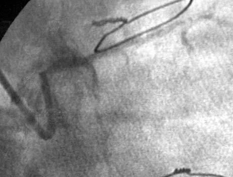 Ratująca życie angioplastyka pnia lewej tętnicy wieńcowej u chorego wysokiego ryzyka 1123 Rycina 2.