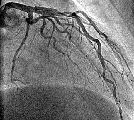Ponowny zawa³ serca prowadz¹cy do niewydolnoœci kr¹ enia 667 Rycina 1. Angiografia lewej têtnicy wieñcowej przed pierwszym zabiegiem angioplastyki Rycina 3.