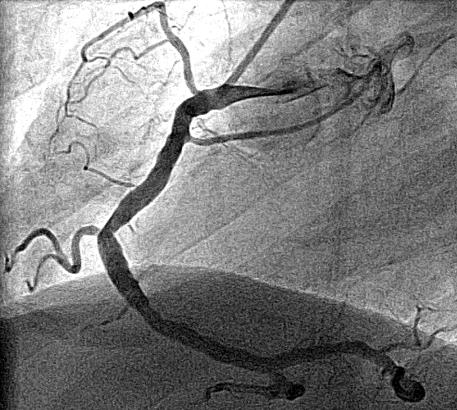 Angiografia prawej têtnicy wieñcowej tego samego chorego œrednio po wszczepieniu stentu pacjent zg³osi³ znaczne zmniejszenie uczucia pieczenia w klatce piersiowej.
