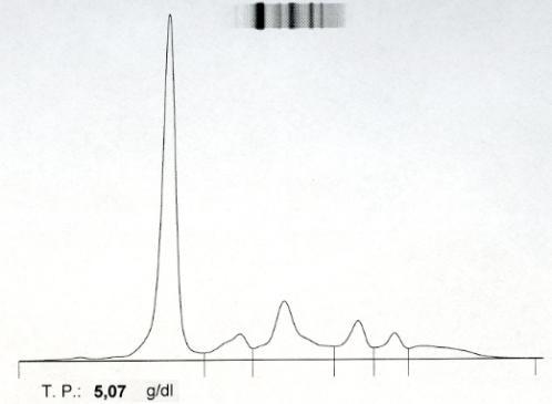 łańcuchy lekkie lambda: 13.51 mg/l FLC k/l: 0.