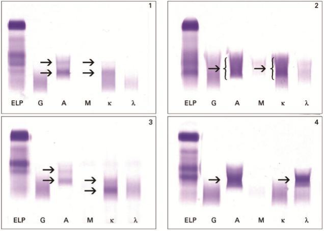 IgA kappa: 3,68 g/l IgA lambda: 0,1 g/l IgAk/IgAl: 37,17 IgA kappa: 17 g/l IgA lambda: 0,38 g/l IgAk/IgAl: 44,39 IgA kappa: 1,04