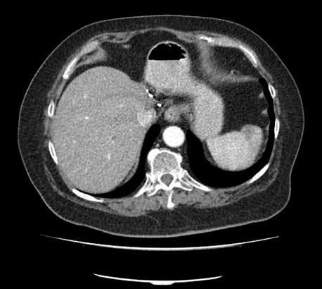 Onkologia w Praktyce Klinicznej 2015, tom 11, supl. H A B Rycina 3. Odpowiedź na leczenie ipilimumabem częściowa remisja zmiany przerzutowej w śledzionie (tomografia komputerowa jamy brzusznej). A. Przed rozpoczęciem leczenia ipilimumabem (sierpień 2014) zmiana przerzutowa w śledzionie średnicy 20 mm; B.