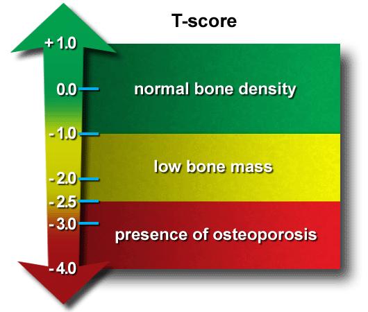 prawidłowa gęstość kości niska masa kostna
