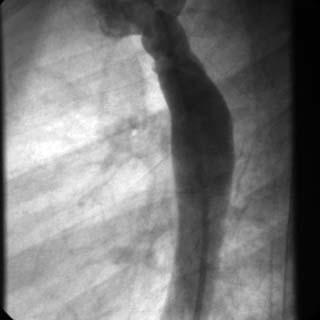 Introduction Coarctation of the aortic isthmus constitutes about 6% of congenital heart defects [1]. In 50% of cases coarctation is associated with bicuspid aortic valve.