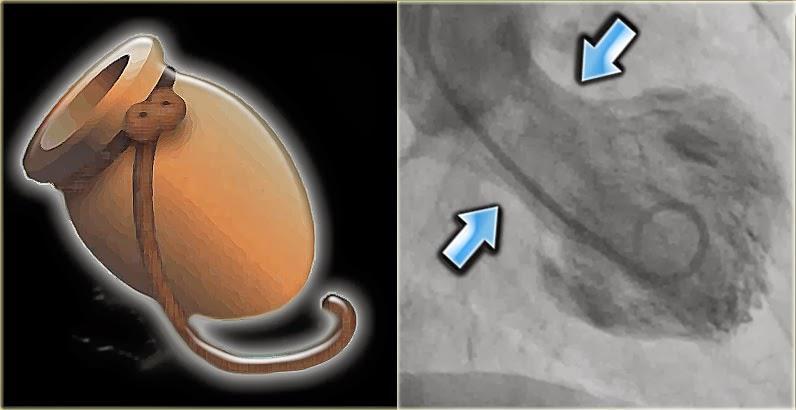 significant coronary artery disease. Z Kardiol 2004; 93:156-161. 7. Tsuchihashi, K., Ueshima, K., Uchida, T.