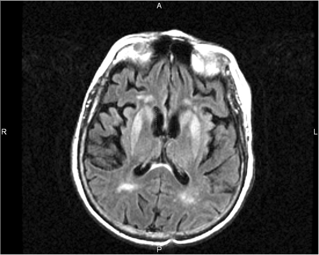 tyczny odczyn na PrP oraz blaszki w przypadkach heterozygot 129 MV. Badanie immunoelektronowo-mikroskopowe wykaza³o obecnoœæ PrP d w agresomach (126,127).