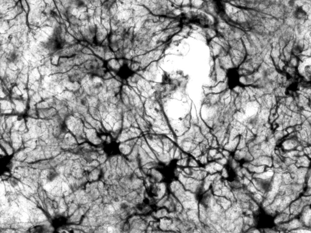 parkinsonism linked to chromosome 17, FTDP-17), zaœ obecnoœæ wakuoli wokó³ j¹der neuronów lub/i komórek gleju jest wyrazem obrzêku mózgu lub zgo³a artefaktem.