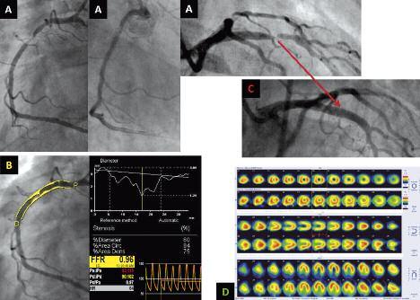Ryc. 7. Przypadek kliniczny nr 4 (opis w tekście) Fig. 7. Case example 4 (see in the text) zwężenia światła naczynia o 50 90%) (zalecenie ESC klasy IA) [3].