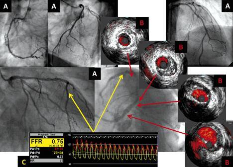 i LAD. W badaniu echokardiograficznym odnotowano: frakcja wyrzutowa lewej komory serca około 50%, EKG wysiłkowe dodatnie klinicznie i elektrokardiograficznie przy obciążeniu 6 MET.