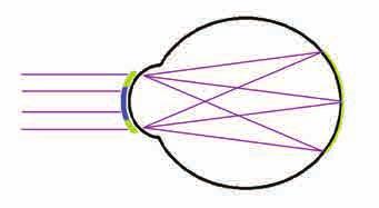 14 Miękkie soczewki łagodzące krótkowzroczność Parametry Ø T średnica całkowita 12.00 do 15.00 19.00 mm Modyfikowalne parametry wtórne, zob. Borelis / Torelis, str.