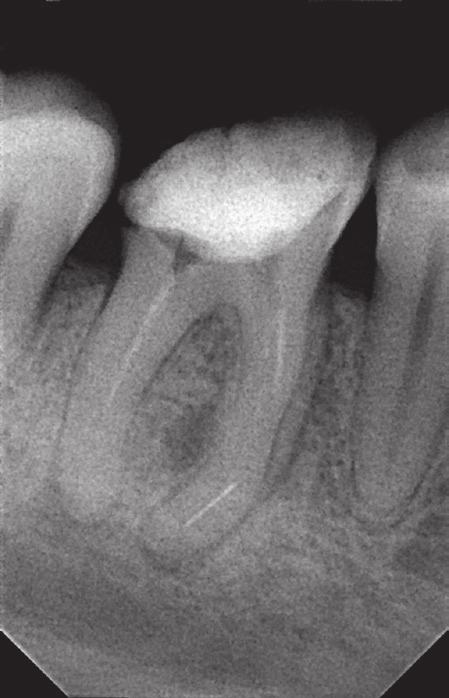 Management of instruments separated intracanally during endodontic treatment J Stoma 2016; 69, 1 Fig. 1. Case 1. Tooth 46 before treatment. Przypadek 1. Ząb 46 przed leczeniem. Fig. 2. Case 1. Tooth 46 after the final filling of mesial canals.