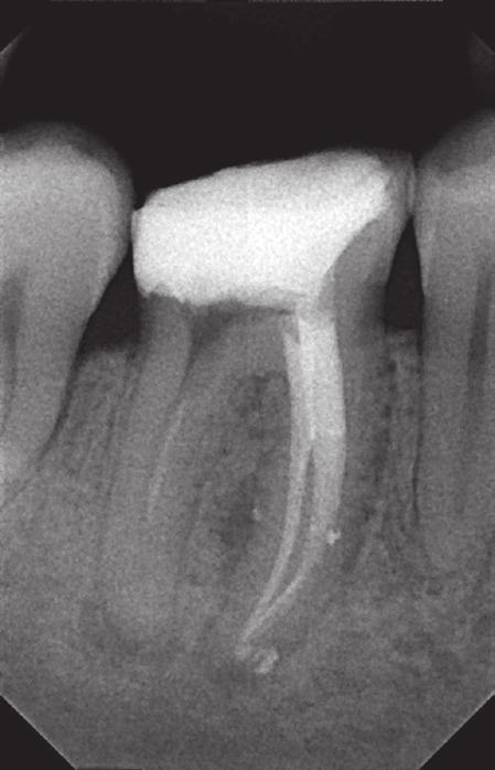treatment was carried out using a dental operating microscope. Creation of a straight-line access was essential to enable maximum visibility of the broken files in mesial canals.