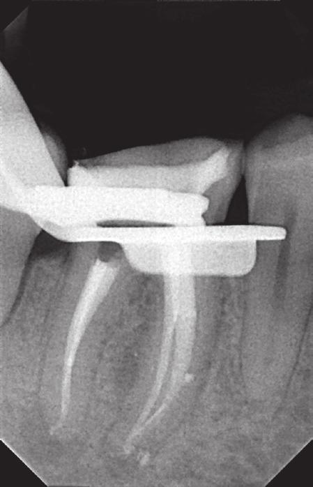 To loosen the broken fragment, the ultrasonic tip BUC # 1A (Obtura Spartan) was used.