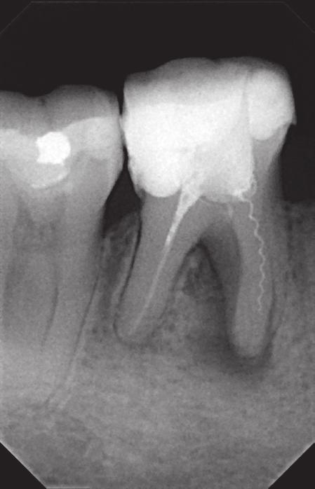Management of instruments separated intracanally during endodontic treatment J Stoma 2016; 69, 1 Fig. 4. Case 2. Tooth 46 before treatment. Przypadek 2. Ząb 46 przed leczeniem. Fig. 5. Case 2. Tooth 46 after the Lentulo spiral removal.