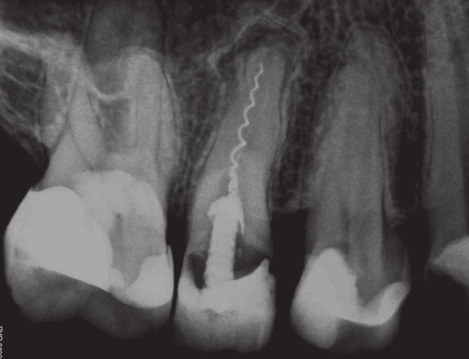 J Stoma 2016; 69, 1 Pietrzycka K., Pawlicka H. SuperEndo α2 and SuperEndo β (B & L Biotech) and AH Plus (DENTSPLY DeTrey) as a sealer.