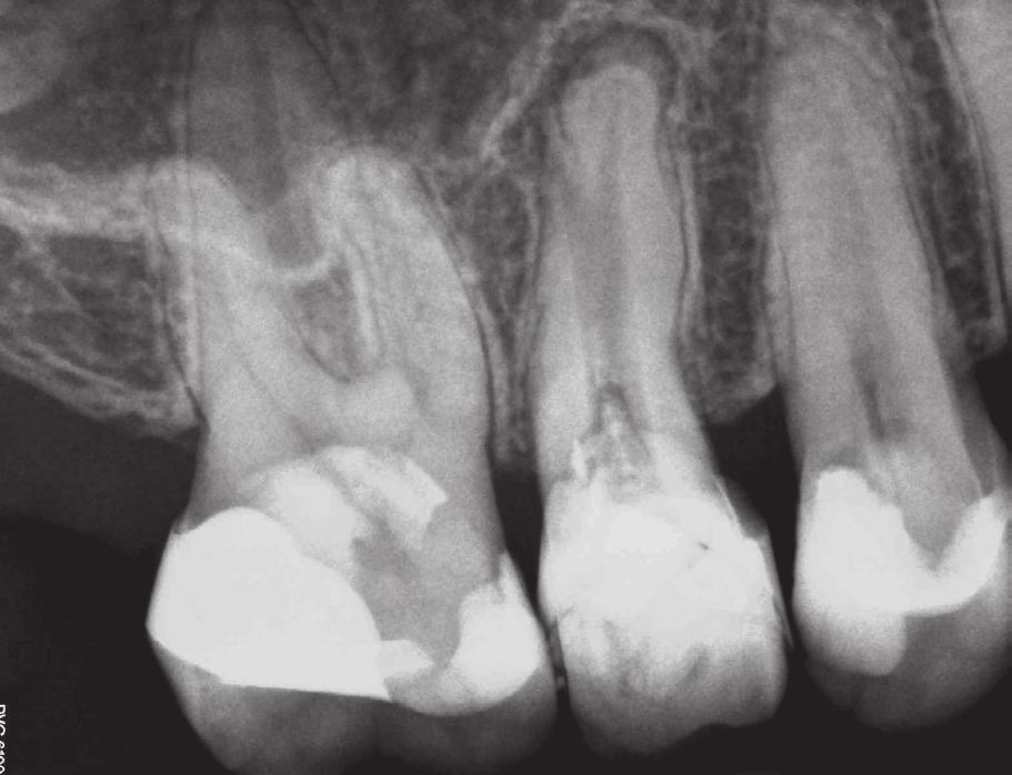 After the final obturation, follow-up RVG was performed (Fig. 6). The patient was referred to her dental practitioner for prosthodontic reconstruction of the crown of the treated tooth.