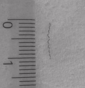 Management of instruments separated intracanally during endodontic treatment J Stoma 2016; 69, 1 Fig. 9. Case 3. Removed Lentulo spiral. Przypadek 3. Usunięta igła Lentulo. Fig. 10. Case 3. Tooth 15 after the final filling of canals.