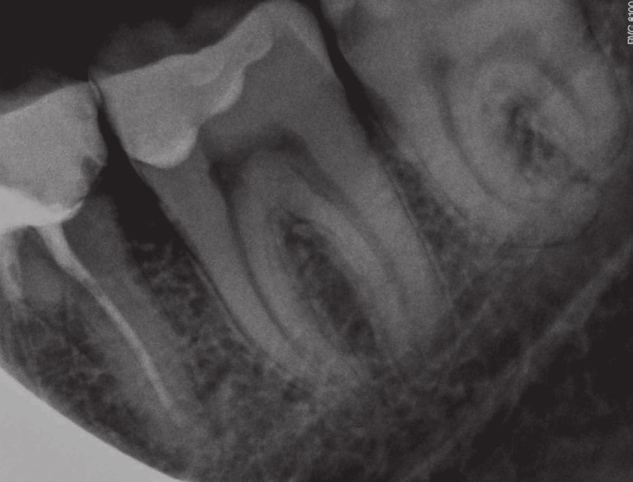 J Stoma 2016; 69, 1 Pietrzycka K., Pawlicka H. Fig. 11. Case 4. Tooth 38 before treatment. Przypadek 4. Ząb 38 przed leczeniem Fig. 12. Case 4. Tooth 38 with a fractured rotary file. Przypadek 4. Ząb 38 ze złamanym narzędziem.