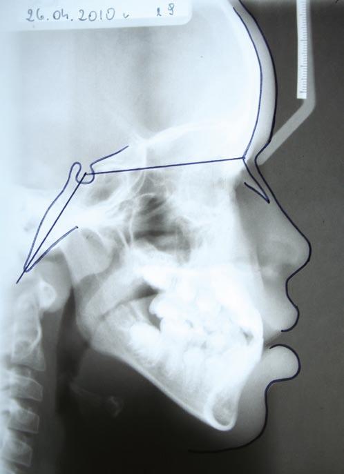 Ryc. 2. Kąt NSBa zmniejszony u pacjenta z III klasą szkieletową. Fig. 2. Smaller NSBa angle in patient with skeletal Class III.