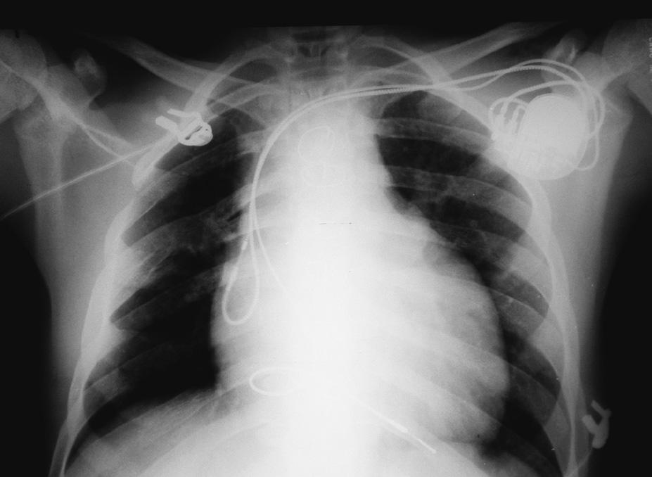 trzewi), po operacyjnej korekcji ubytku w przegrodzie międzyprzedsionkowej (ASD, atrial septal defect) typu sinus venosus, z częściowym nieprawidłowym spływem żył płucnych (w 1 rż.
