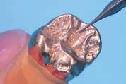 Mikrofrezy Frezy do bruzd OPK B153 NF 02 10 szt. 500 104 153006 002 śr. 0,2 mm B153 NF 04 10 szt. 500 104 153006 004 śr. 0,4 mm B153 NF 06 10 szt.