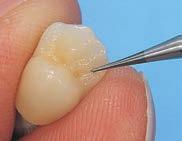 metali. Frezy o średnicy 0,4 mm, 0,5 mm, 0,6 mm znakomicie sprawdzają się przy wykonywaniu bruzd na powierzchniach żujących koron ceramicznych.