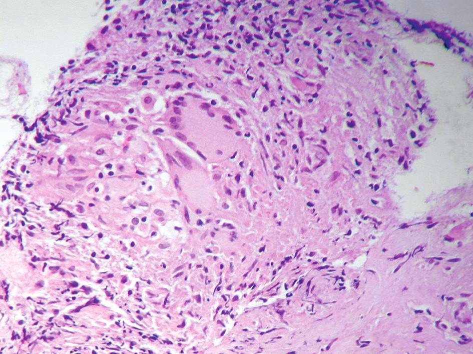 DIAGNOSTYKA MORFOLOGICZNA W CHOROBACH PŁUC. RODZAJE Rycina 7. Bronchofiberoskopia.