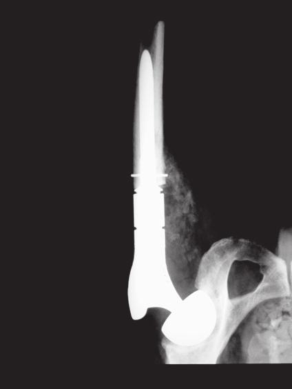 Minimalny zakres resekcji kości wynosił 6 centymetrów, natomiast maksymalny 24, średnio 12 centymetrów. Implantowano 28 protez GMRS Stryker oraz 36 MUTARS Implant Cast.