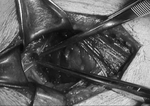 Intraoperative view: following transsection of the superior transverse scapular ligament (stumps of ligament in tweezers) uwidocznieniu nerwu nad³opatkowego przecinano wiêzad³o górne poprzeczne