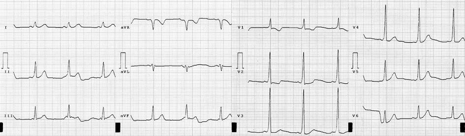 roku życia udokumentowano w EKG częstoskurcz typu AVRT 220/min. Po konwersji do rytmu zatokowego (adenozyna i.v.) rozpoznano zespół Wolffa-Parkinsona- -White a (WPW).
