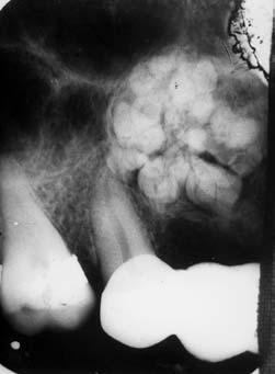 426 A. JANAS, G. GRZESIAK JANAS as 11 reduced teeth. In most cases, however, odontomata did not exceed 2 cm, and in all these cases there were no visible symptoms of illness.