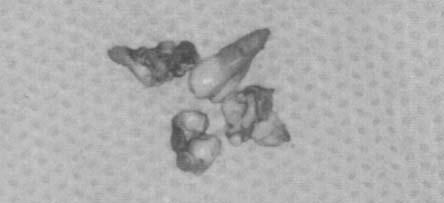 process) Brak zęba stałego 3 2 1 w łuku zębowym (Lack of a per manent tooth) Wykryte przy 4 4 padkowo na zdjęciu RTG (Found by accident at an X ray examination)) Razem 9 7 2 Wyniki Analizowano