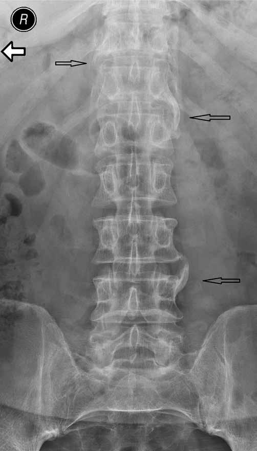 Iwona Sudoł-Szopińska, Genowefa Matuszewska, Brygida Kwiatkowska, Grzegorz Pracoń A B Fig. 4. Lumbar spine AP X-ray of the 34 y.o. female patient with suspected PsA: osteoporosis, parasyndesmophytes