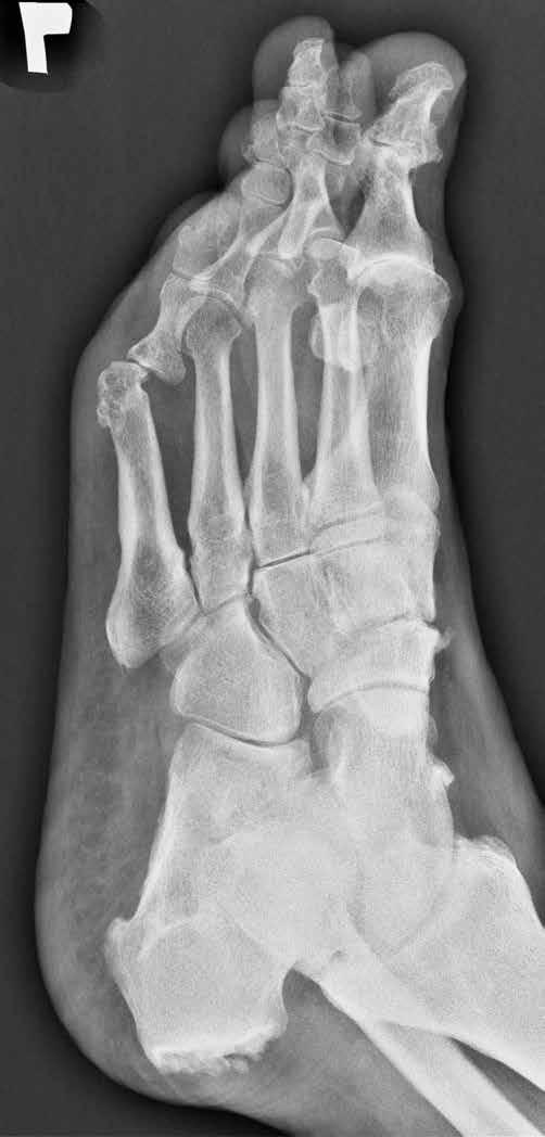 Diagnostic imaging of psoriatic arthritis.