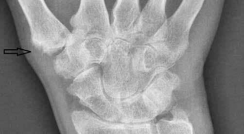 Iwona Sudoł-Szopińska, Genowefa Matuszewska, Brygida Kwiatkowska, Grzegorz Pracoń B A D C Fig. 1. Polyarticular PsA in 32 y.o. female, X-rays, A.