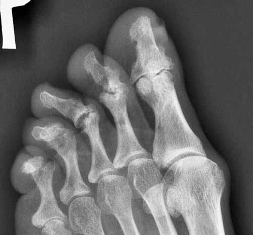 right forefoot, AP at the top, oblique at the bottom: MTP 5 joint space narrowing, erosions of the medial part of the great toe s proximal phalanx and lateral aspect of the 5th metatarsal s head,