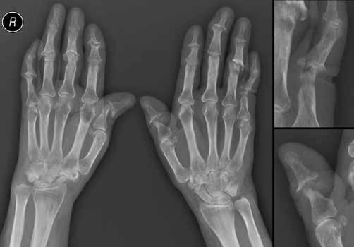 Iwona Sudoł-Szopińska, Genowefa Matuszewska, Brygida Kwiatkowska, Grzegorz Pracoń Fig. 2. X-ray of the hands of the 53 y.o. female patient with PsA and erosive osteoarthritis, on the left AP, on the