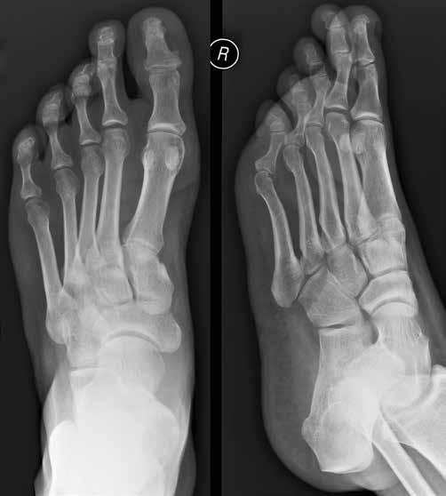 right and 3 rd finger of the left hand, subluxation of the IP joint of the right thumb and left hand s PIP 4 joint, joint space narrowing in a few interphalangeal joints and in both wrist regions,