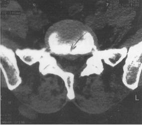 Ryc.32 Obraz tomografii komputerowej pacjenta z przewlekłymi dolegliwościami bólowymi lędźwiowego odcinka kręgosłupa.
