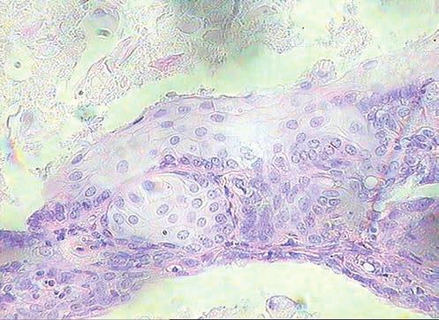 Prace kliniczne i kazuistyczne Ovarian serous adenocarcinoma in the bitch. Case report Katkiewicz M.