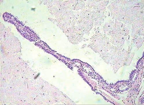 They were identified as serous type cells, squamous cells and highly differentiated, similar to ovarian, epithelial cells.