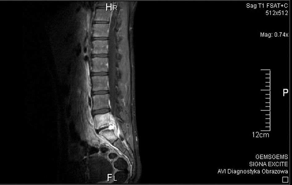 napięciem mięśni przykręgosłupowych w odcinku lędźwiowym kręgosłupa. Ponadto stwierdzono ograniczenie ruchomości kręgosłupa objaw Schobera 2 cm, Otta 2 cm, odległość palce podłoga 35 cm.
