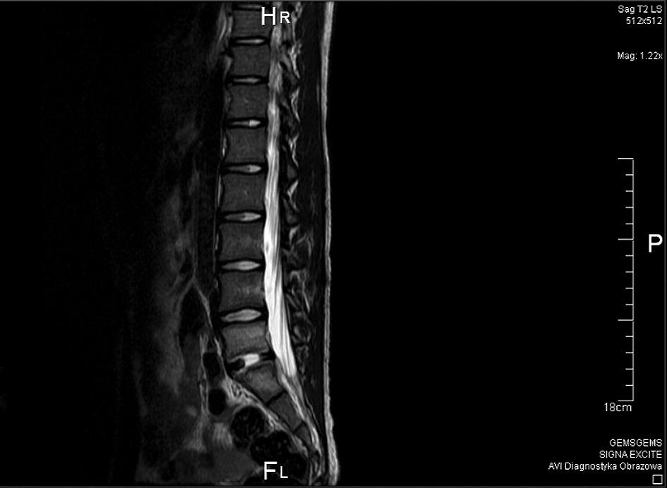 Różnicowanie zapalenia krążka międzykręgowego i seronegatywnej spondyloartropatii 211 Ryc. 3. Obraz MRI kręgosłupa lędźwiowego (czas T2) po 4 tygodniach antybiotykoterapii. Fig. 3. Lumbar spine (T2) MRI after 4 weeks of gosłupowego (ryc.