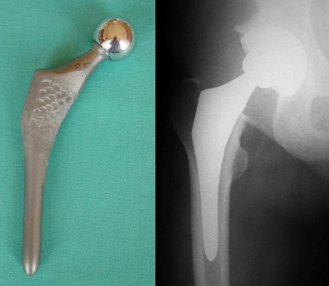 celu zwiększenie przeżywalności implantów z jednej strony, a z drugiej zmniejszenie ścieralności powierzchni kontaktowych.