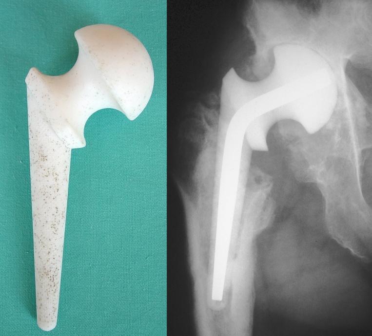 Endoproteza przynasadowa typu Proxima stawu biodrowego prawego: a konstrukcja; widok od przodu, b rentgenogram w projekcji przednio-tylnej a b Osobną generację endoprotez stawu biodrowego stanowią