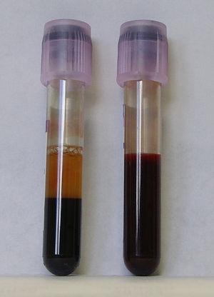 Osocze krwi Osocze krwi (patrz lewa probówka) płynny składnik krwi o słomkowej barwie w nim zawieszone są komórki transportuje cząsteczki niezbędne komórkom (elektrolity, białka, składniki odżywcze)