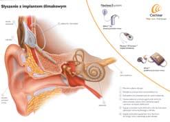 07 Zasada działania implantu ślimakowego Źródło: materiały Medicus Fot.